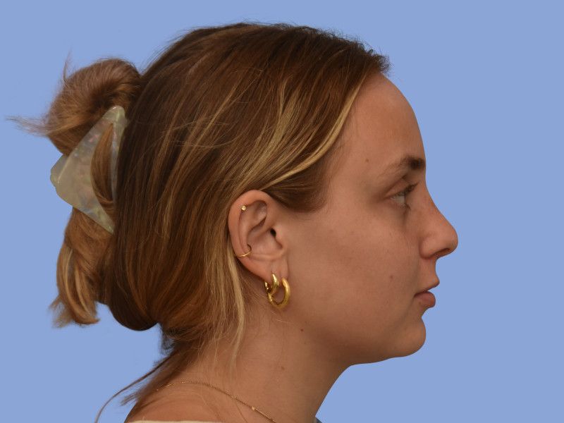 Rhinoplasty before & after photo