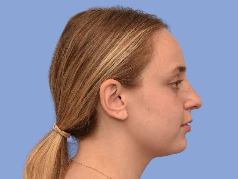 Rhinoplasty before & after photo