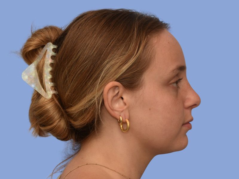 Rhinoplasty before & after photo